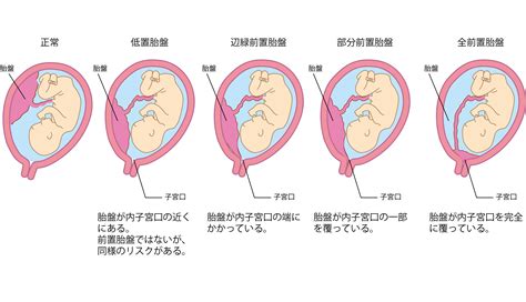 低位前置胎盤